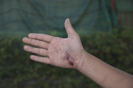 dog bite hand infection